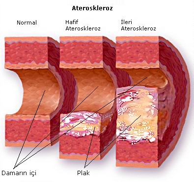 kolesterol tinggi1 Atasi Masalah Kolesterol: Panduan Turunkan Paras Kolesterol