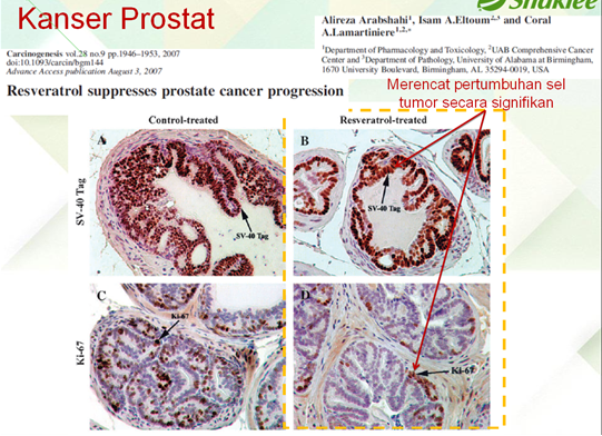 Vivix Kanser Prostat Bagaimana Resveratrol Membantu Pesakit Diabetes, Kanser & Jantung?   Kajian Saintifik Membuktikannya.